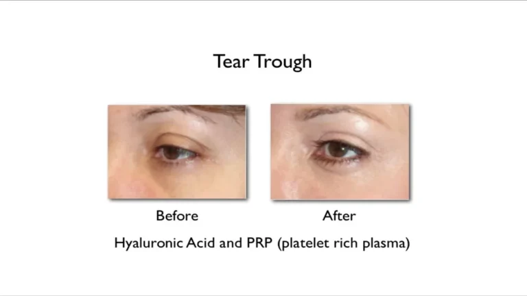 Discover How Tear Trough Fillers Can Banish Tired Eyes