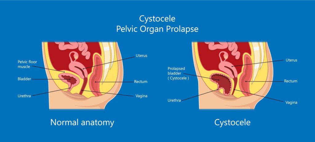 Pelvic Prolapse and Female Incontinence